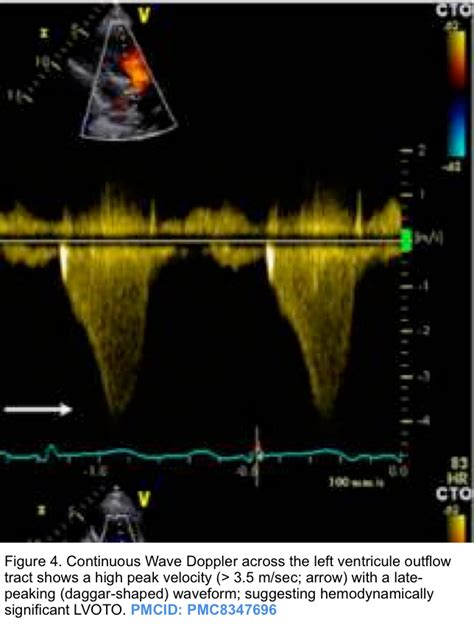 lv obstroction flow dagger shape|dynamic lv outflow obstruction.